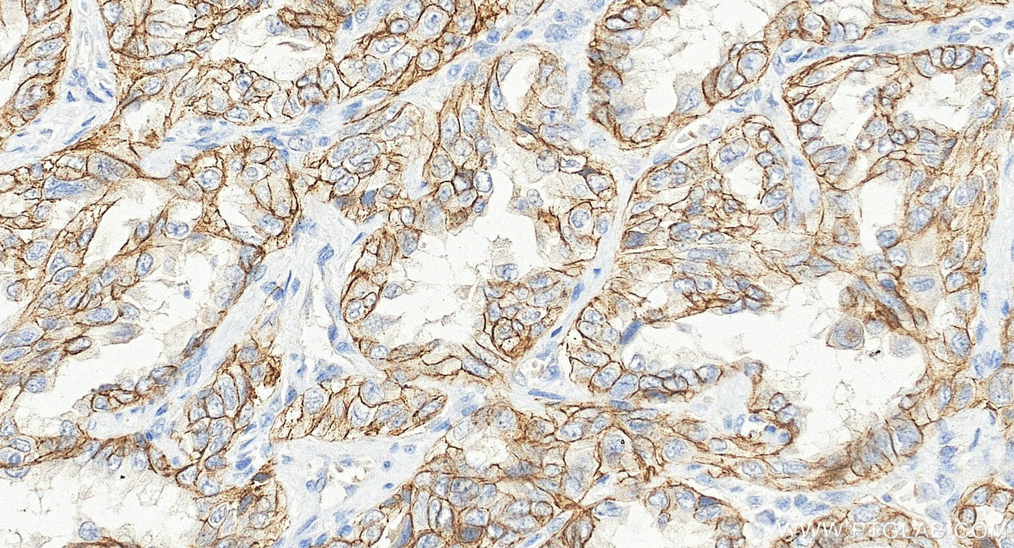 Immunohistochemistry (IHC) staining of human lung cancer tissue using DSG2 Polyclonal antibody (21880-1-AP)