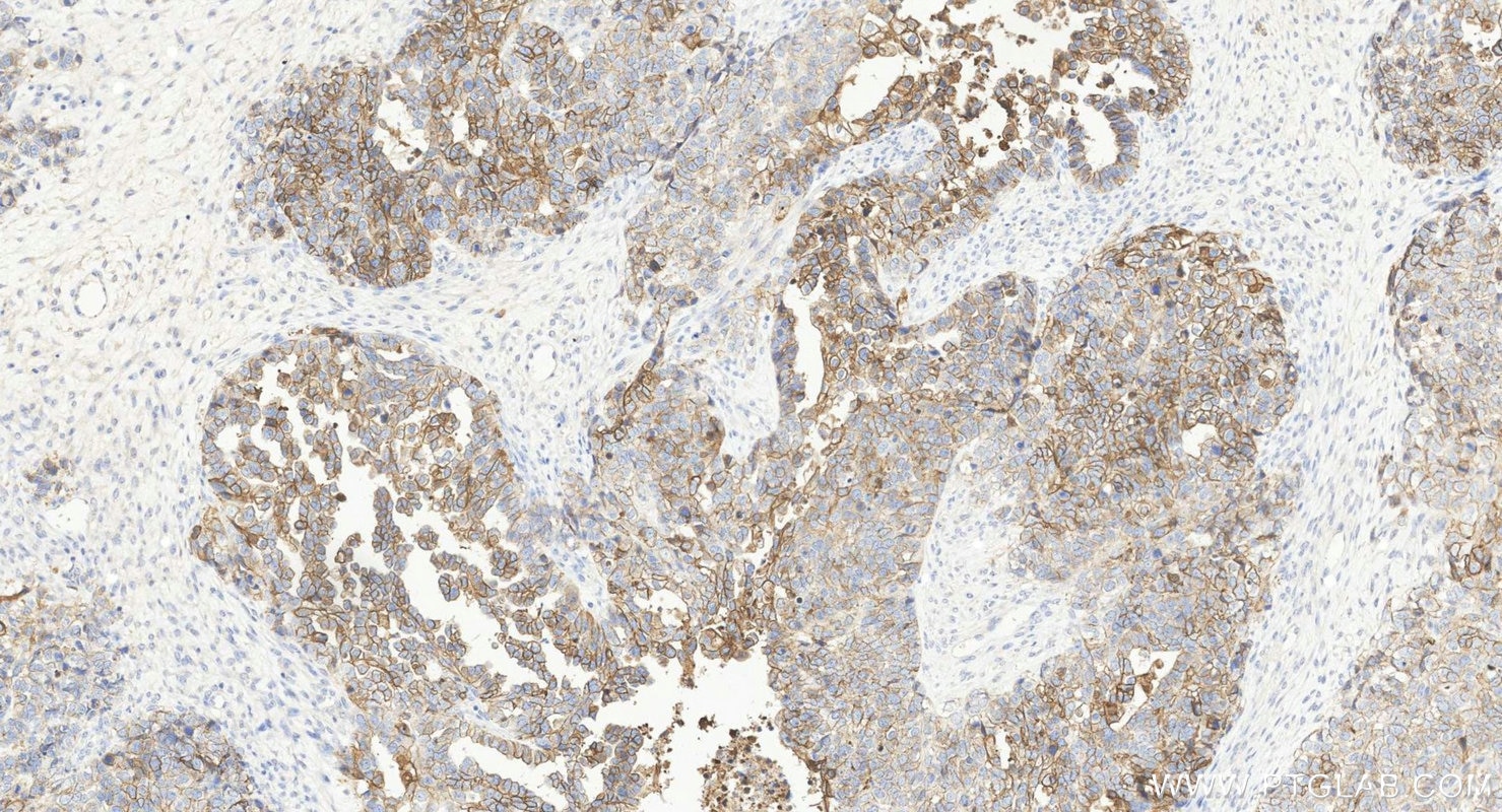 Immunohistochemistry (IHC) staining of human ovary cancer tissue using DSG2 Polyclonal antibody (21880-1-AP)
