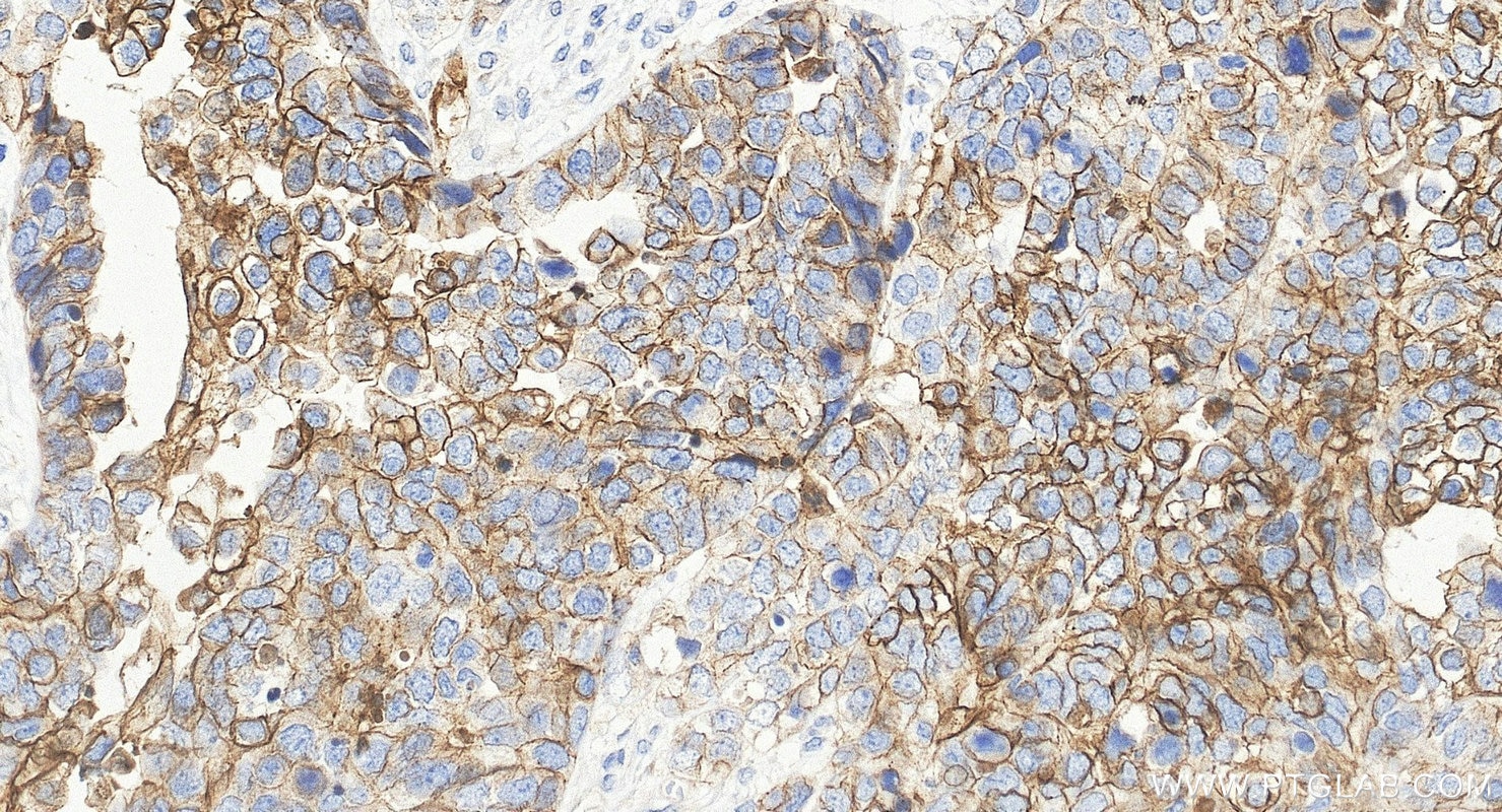 Immunohistochemistry (IHC) staining of human ovary cancer tissue using DSG2 Polyclonal antibody (21880-1-AP)