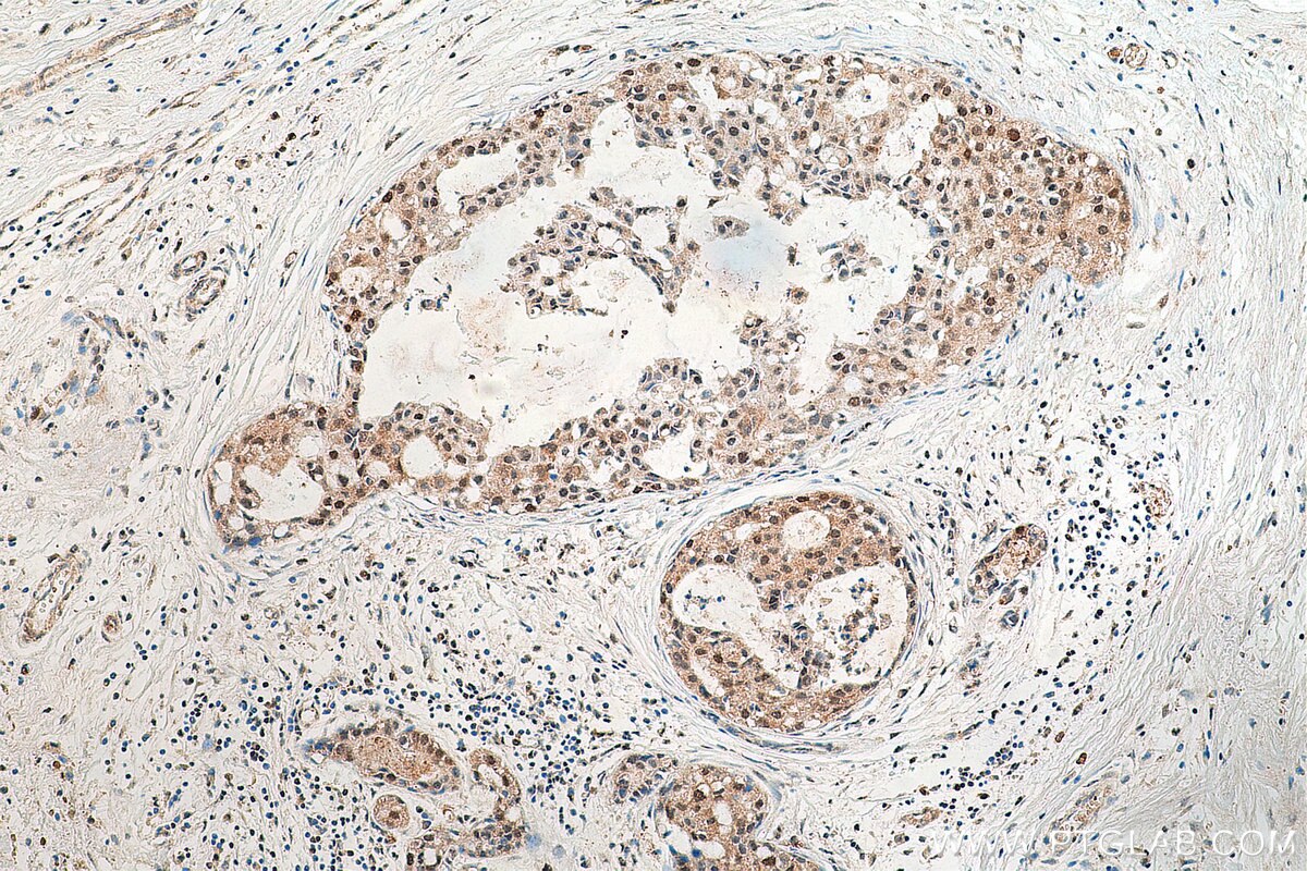 Immunohistochemistry (IHC) staining of human breast cancer tissue using DSN1 Polyclonal antibody (17742-1-AP)
