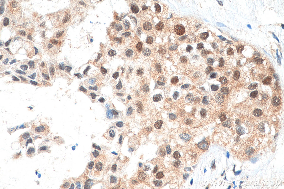 Immunohistochemistry (IHC) staining of human breast cancer tissue using DSN1 Polyclonal antibody (17742-1-AP)