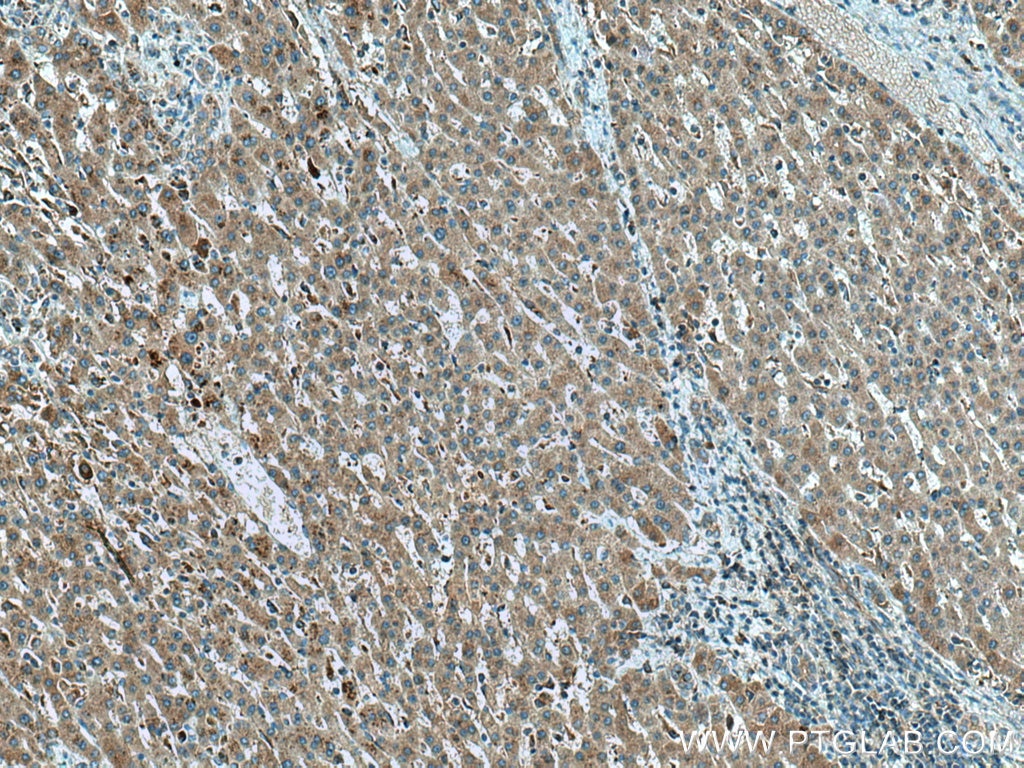 Immunohistochemistry (IHC) staining of human liver cancer tissue using DST Polyclonal antibody (28438-1-AP)