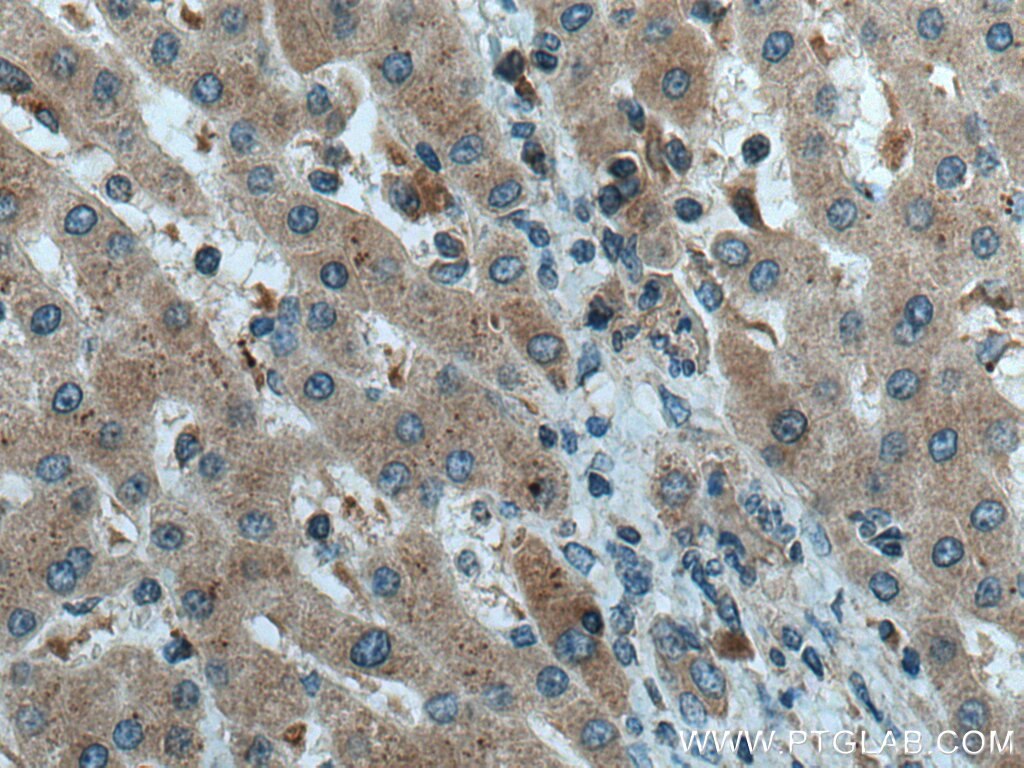 Immunohistochemistry (IHC) staining of human liver cancer tissue using DST Polyclonal antibody (28438-1-AP)