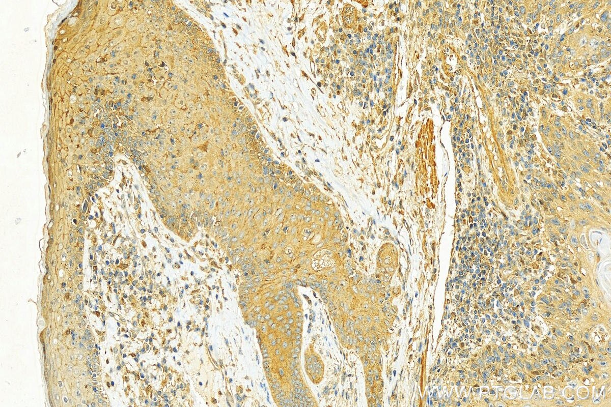 Immunohistochemistry (IHC) staining of human skin cancer tissue using Destrin Polyclonal antibody (10962-2-AP)