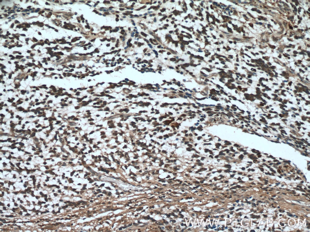 Immunohistochemistry (IHC) staining of human gliomas tissue using DTX1 Polyclonal antibody (18350-1-AP)