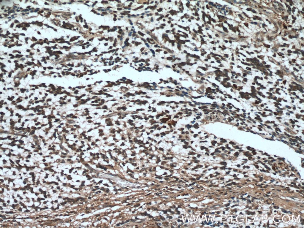 IHC staining of human gliomas using 18350-1-AP