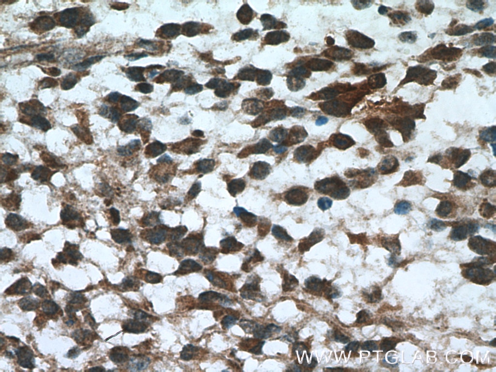 Immunohistochemistry (IHC) staining of human gliomas tissue using DTX1 Polyclonal antibody (18350-1-AP)