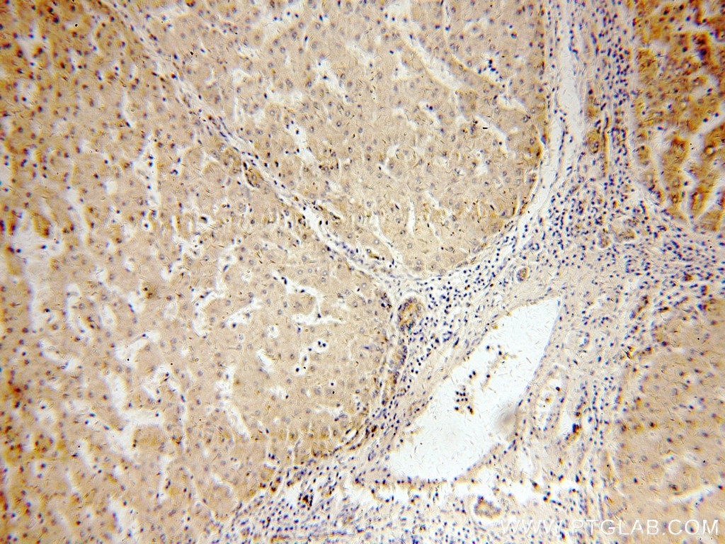 Immunohistochemistry (IHC) staining of human hepatocirrhosis tissue using DTX2 Polyclonal antibody (18565-1-AP)