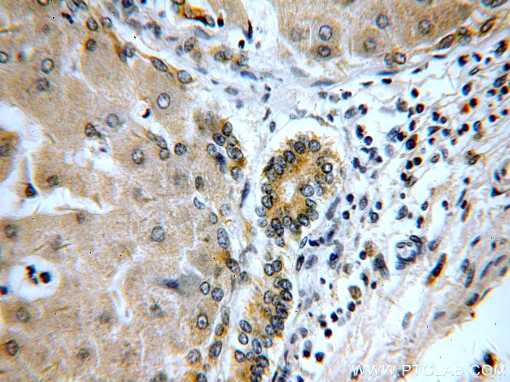 IHC staining of human hepatocirrhosis using 18565-1-AP