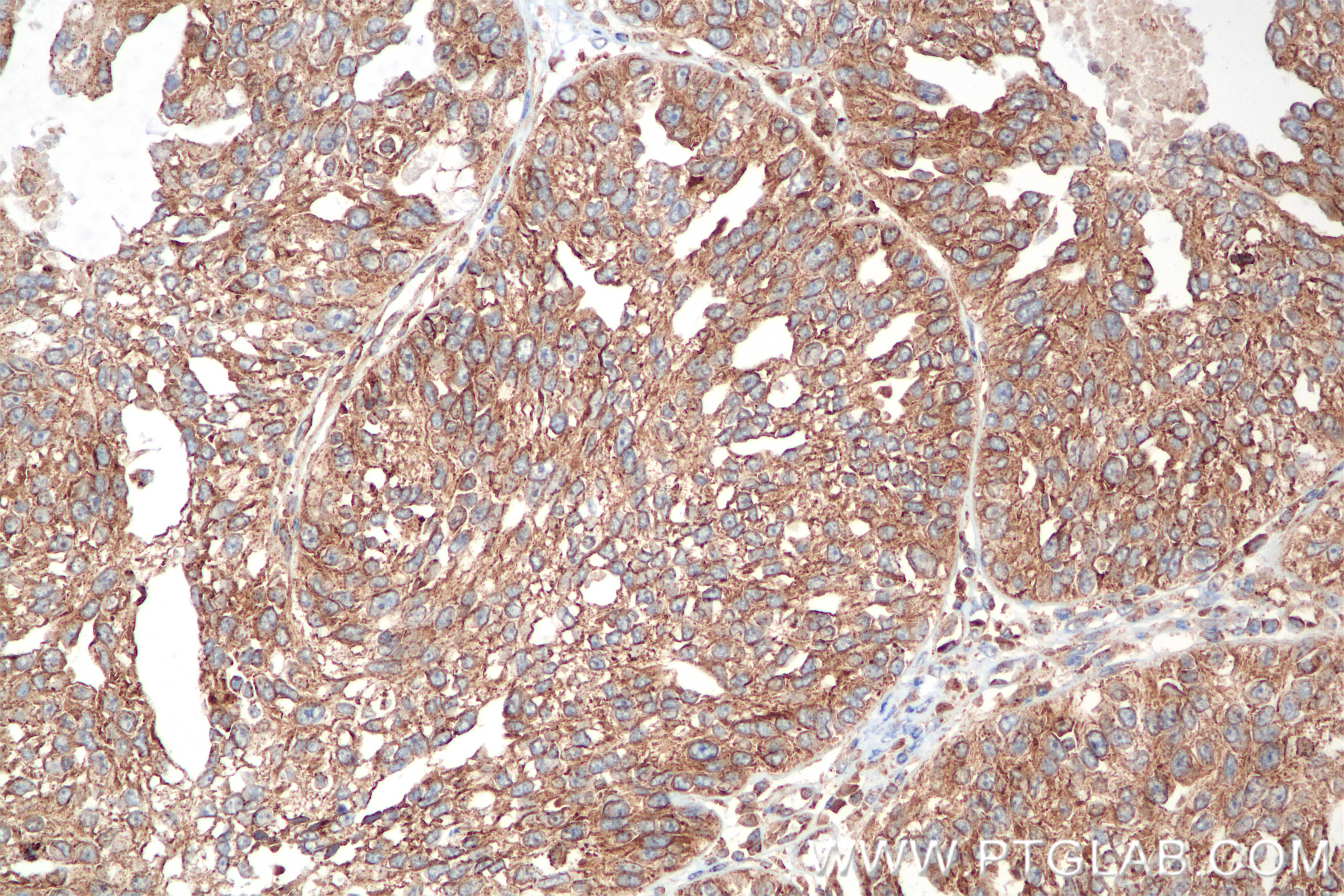 Immunohistochemistry (IHC) staining of human ovary cancer tissue using DTX3L Recombinant antibody (85340-2-RR)