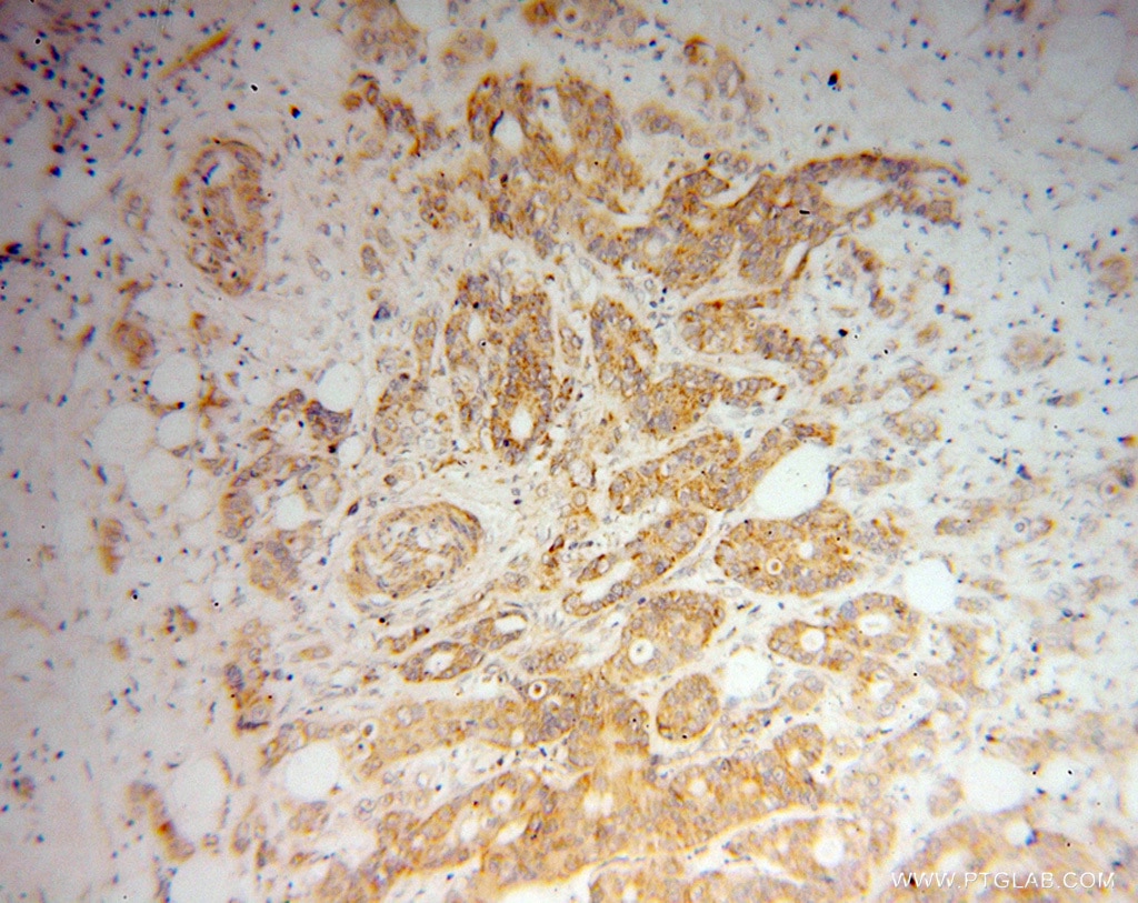 Immunohistochemistry (IHC) staining of human colon cancer tissue using DTYMK Polyclonal antibody (15360-1-AP)
