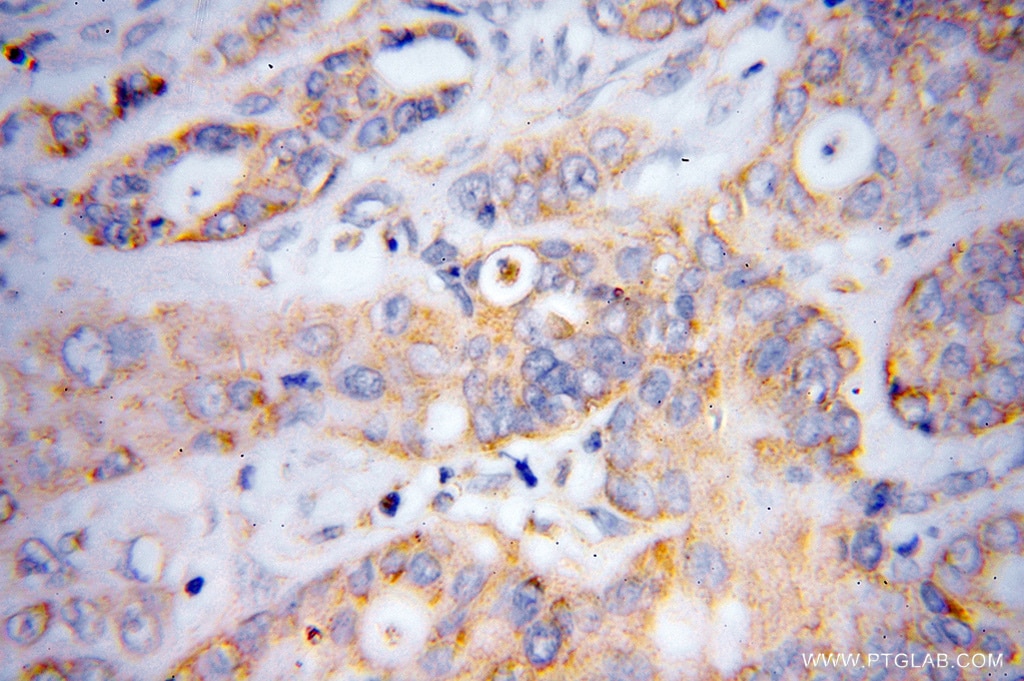 Immunohistochemistry (IHC) staining of human colon cancer tissue using DTYMK Polyclonal antibody (15360-1-AP)