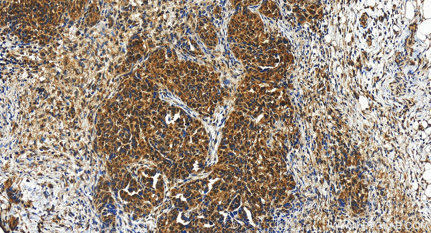 Immunohistochemistry (IHC) staining of human ovary cancer tissue using DULLARD Polyclonal antibody (22088-1-AP)