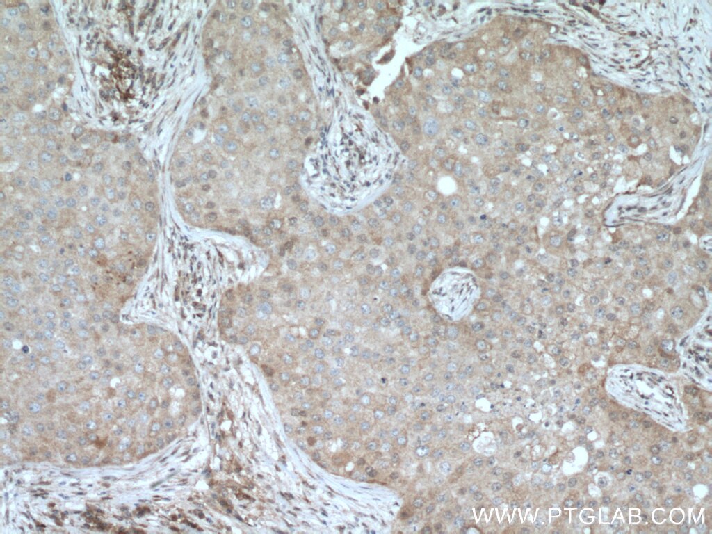 Immunohistochemistry (IHC) staining of human breast cancer tissue using DUS3L Polyclonal antibody (15643-1-AP)