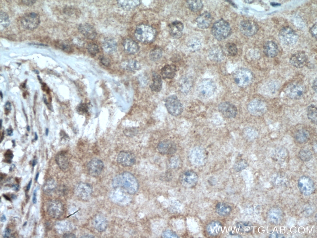 Immunohistochemistry (IHC) staining of human breast cancer tissue using DUS3L Polyclonal antibody (15643-1-AP)