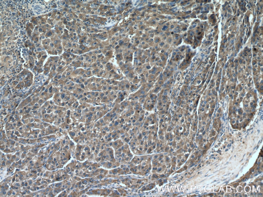 Immunohistochemistry (IHC) staining of human liver cancer tissue using DUS4L Polyclonal antibody (21870-1-AP)