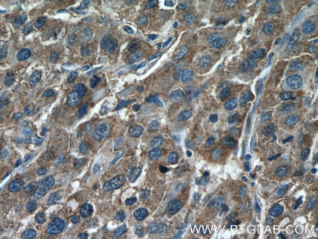 IHC staining of human liver cancer using 21870-1-AP