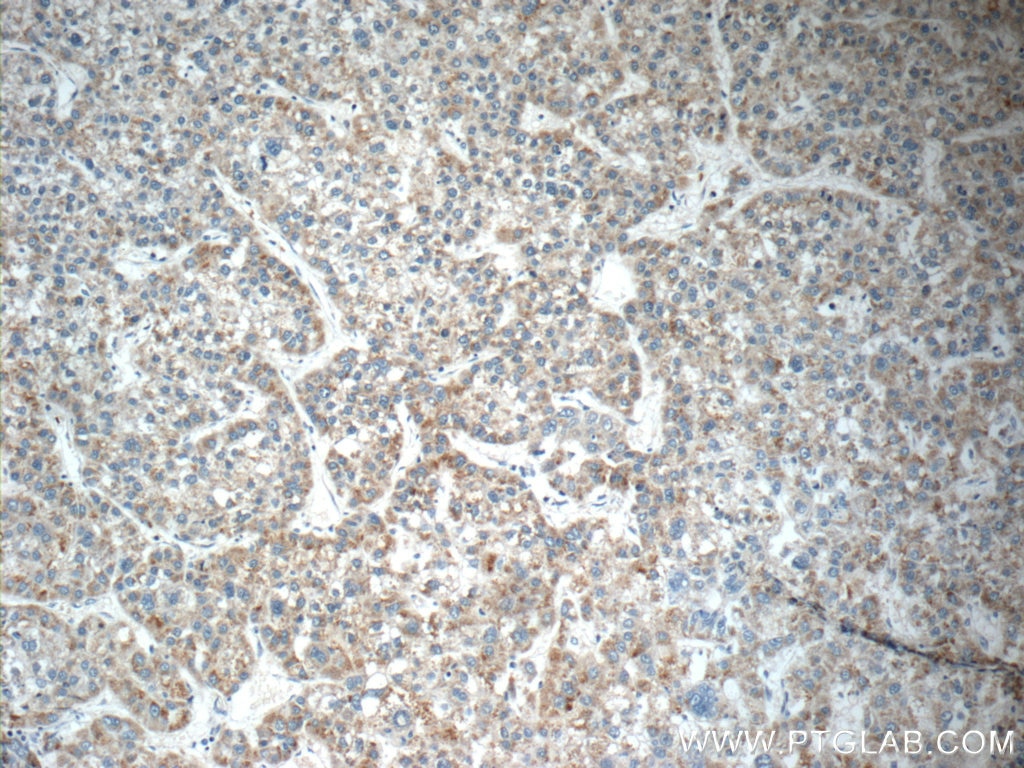 Immunohistochemistry (IHC) staining of human liver cancer tissue using DUSP10 Polyclonal antibody (11689-1-AP)