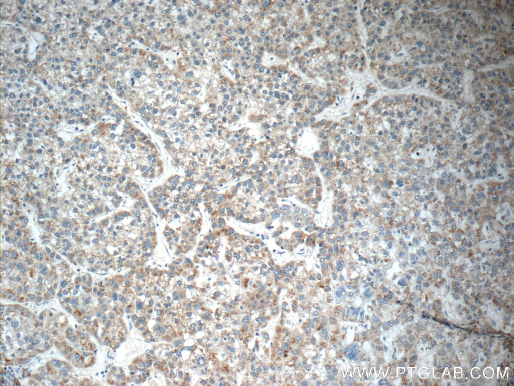 Immunohistochemistry (IHC) staining of human liver cancer tissue using DUSP10 Polyclonal antibody (11689-1-AP)