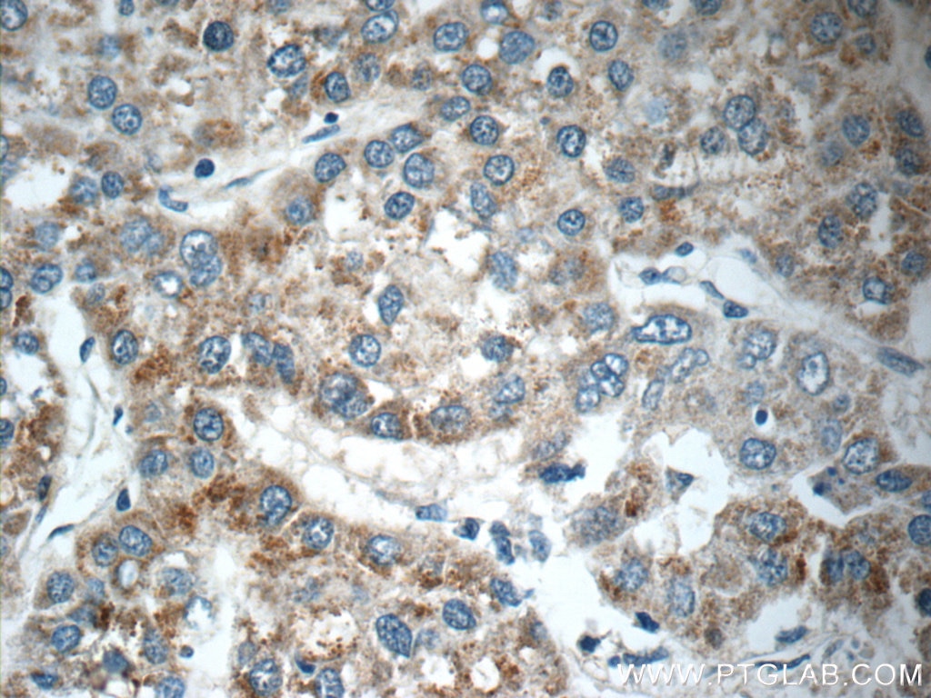 Immunohistochemistry (IHC) staining of human liver cancer tissue using DUSP10 Polyclonal antibody (11689-1-AP)
