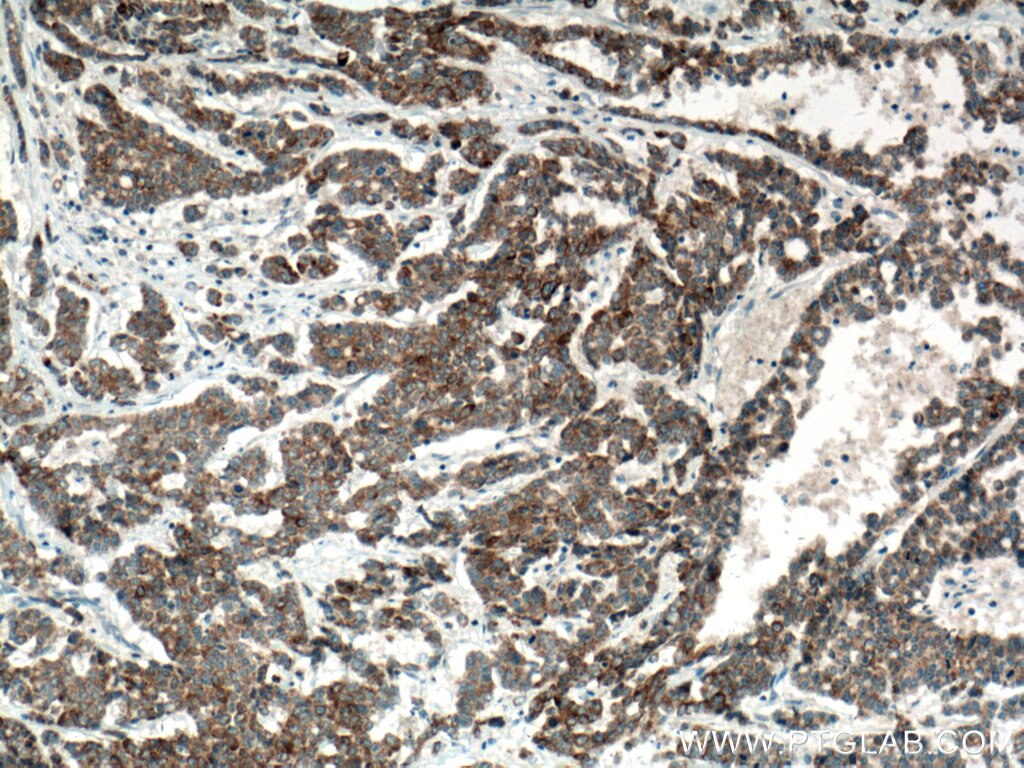 Immunohistochemistry (IHC) staining of human colon cancer tissue using DUSP13 Polyclonal antibody (10909-1-AP)