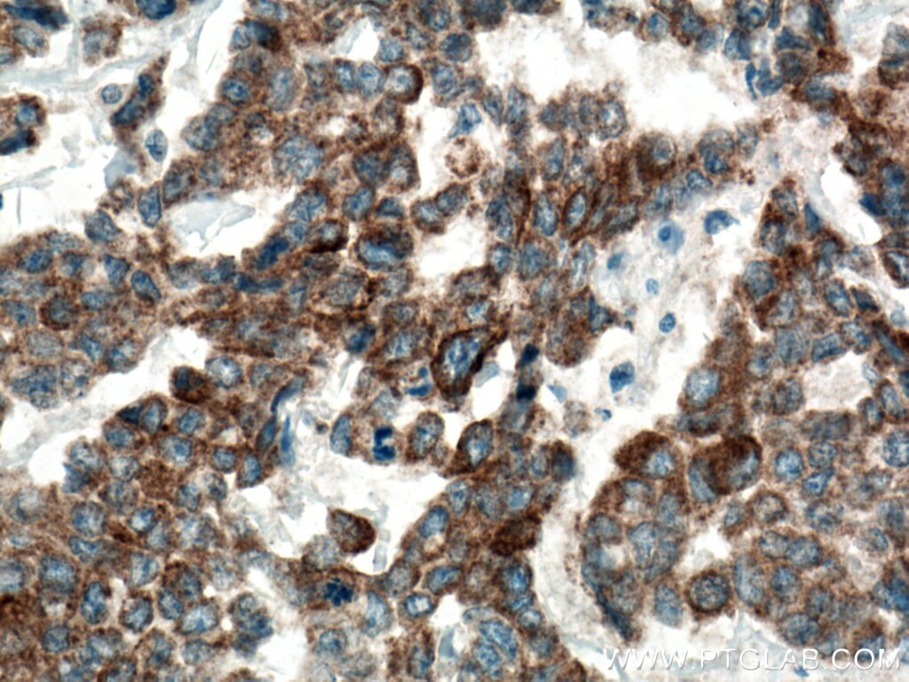 Immunohistochemistry (IHC) staining of human colon cancer tissue using DUSP13 Polyclonal antibody (10909-1-AP)