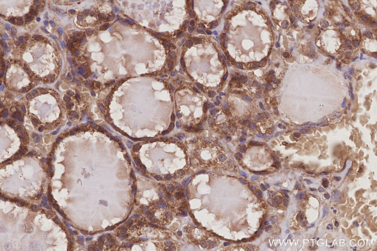 Immunohistochemistry (IHC) staining of human thyroid cancer tissue using DUSP13 Polyclonal antibody (10909-1-AP)
