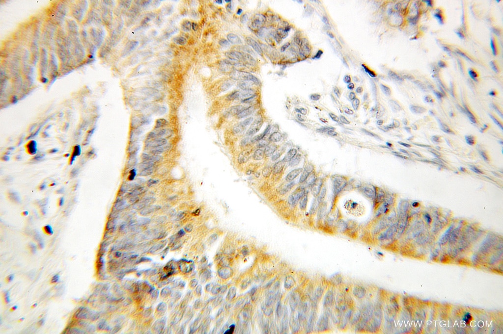 Immunohistochemistry (IHC) staining of human colon cancer tissue using DUSP13 Polyclonal antibody (10909-1-AP)