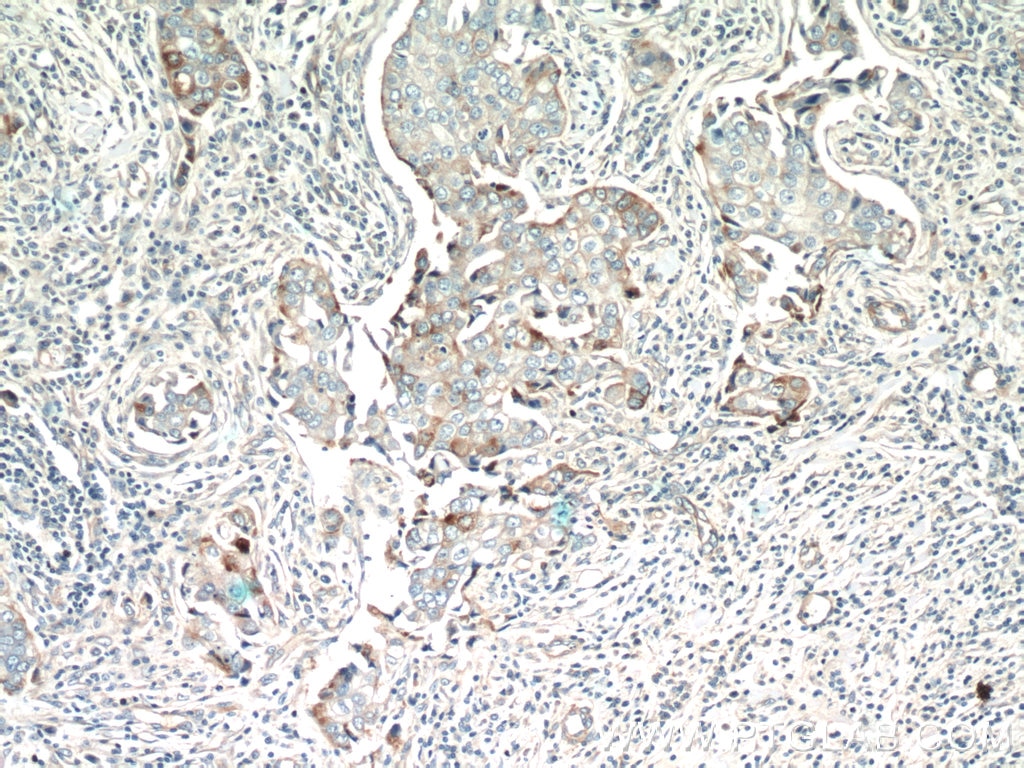 IHC staining of human breast cancer using 14237-1-AP