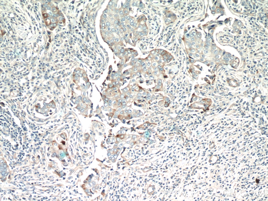 Immunohistochemistry (IHC) staining of human breast cancer tissue using DUSP16 Polyclonal antibody (14237-1-AP)