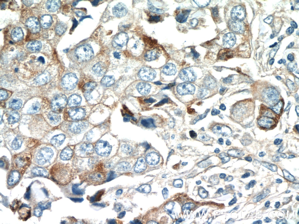 Immunohistochemistry (IHC) staining of human breast cancer tissue using DUSP16 Polyclonal antibody (14237-1-AP)