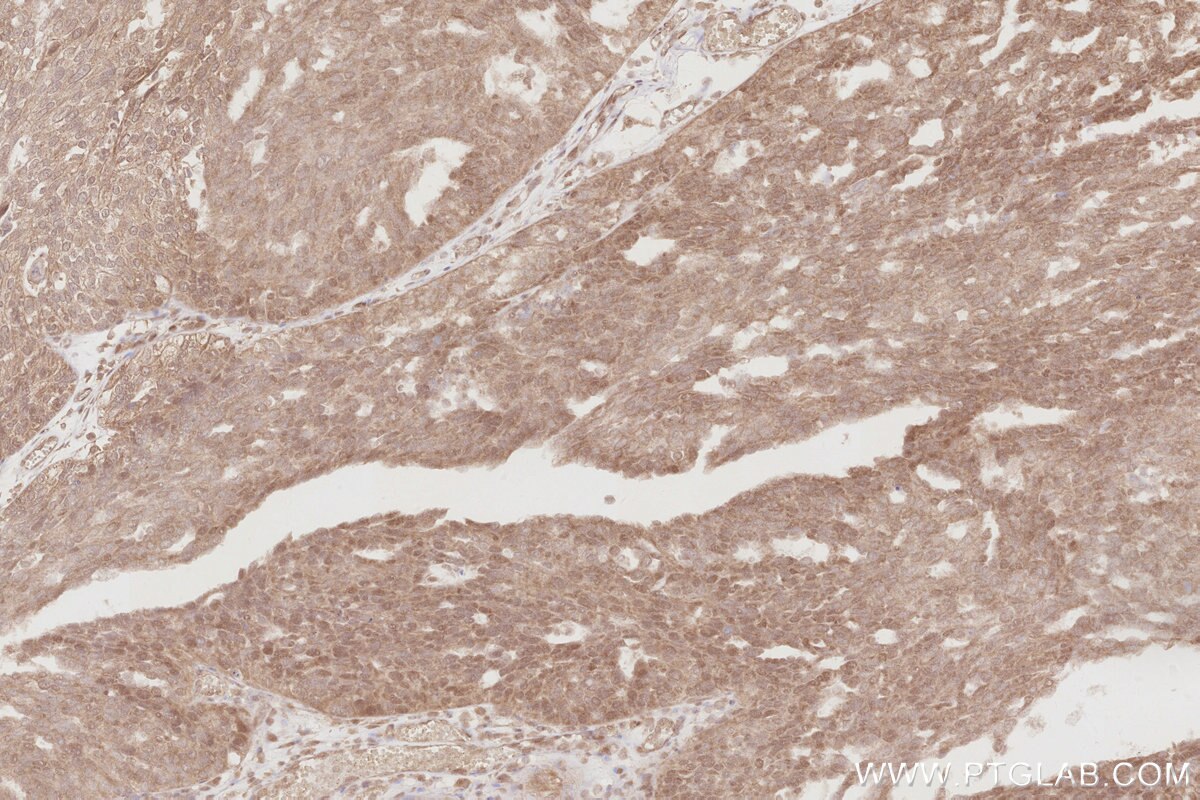 Immunohistochemistry (IHC) staining of human ovary cancer tissue using DUSP16 Polyclonal antibody (14237-1-AP)