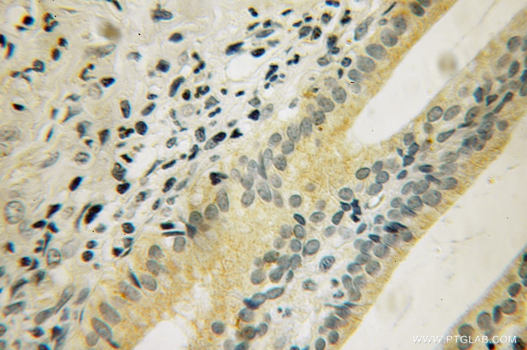 Immunohistochemistry (IHC) staining of human pancreas cancer tissue using DUSP19 Polyclonal antibody (12924-1-AP)