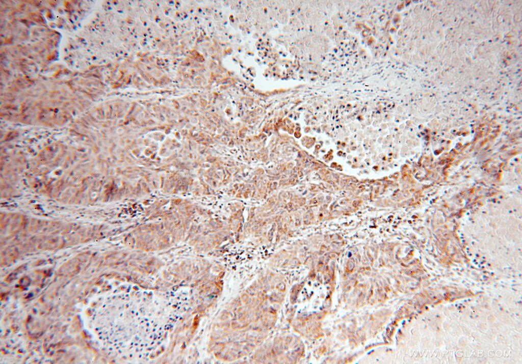 Immunohistochemistry (IHC) staining of human lung cancer tissue using DUSP22 Polyclonal antibody (16514-1-AP)