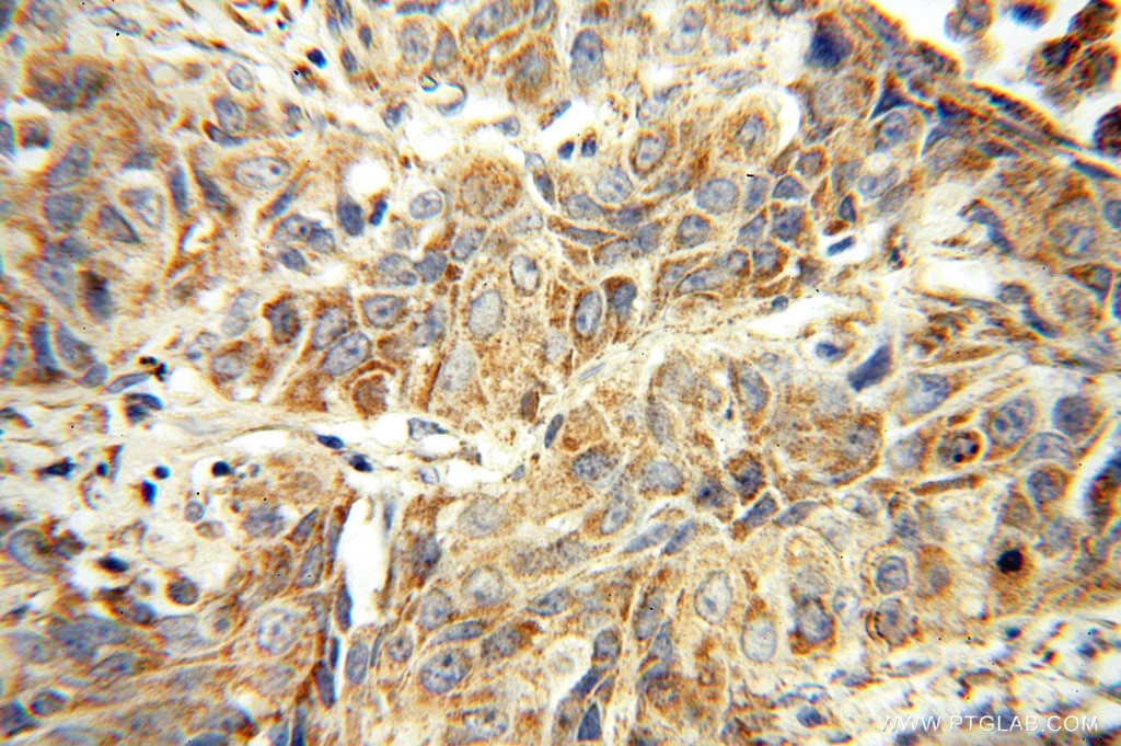 Immunohistochemistry (IHC) staining of human lung cancer tissue using DUSP22 Polyclonal antibody (16514-1-AP)
