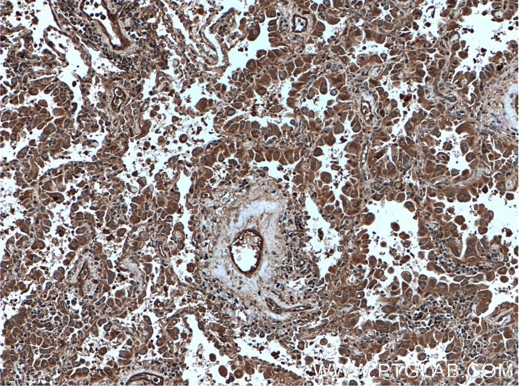 Immunohistochemistry (IHC) staining of human lung cancer tissue using DUSP22 Polyclonal antibody (51005-2-AP)