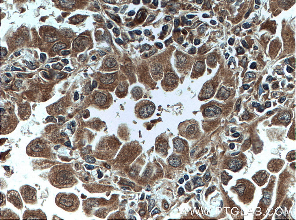 Immunohistochemistry (IHC) staining of human lung cancer tissue using DUSP22 Polyclonal antibody (51005-2-AP)