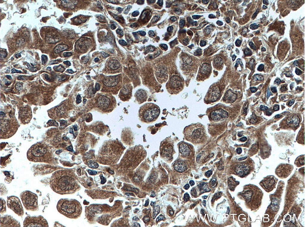 Immunohistochemistry (IHC) staining of human lung cancer tissue using DUSP22 Polyclonal antibody (51005-2-AP)