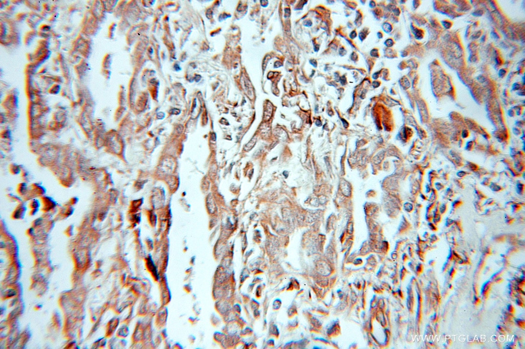 Immunohistochemistry (IHC) staining of human lung cancer tissue using DUSP22 Polyclonal antibody (51005-2-AP)