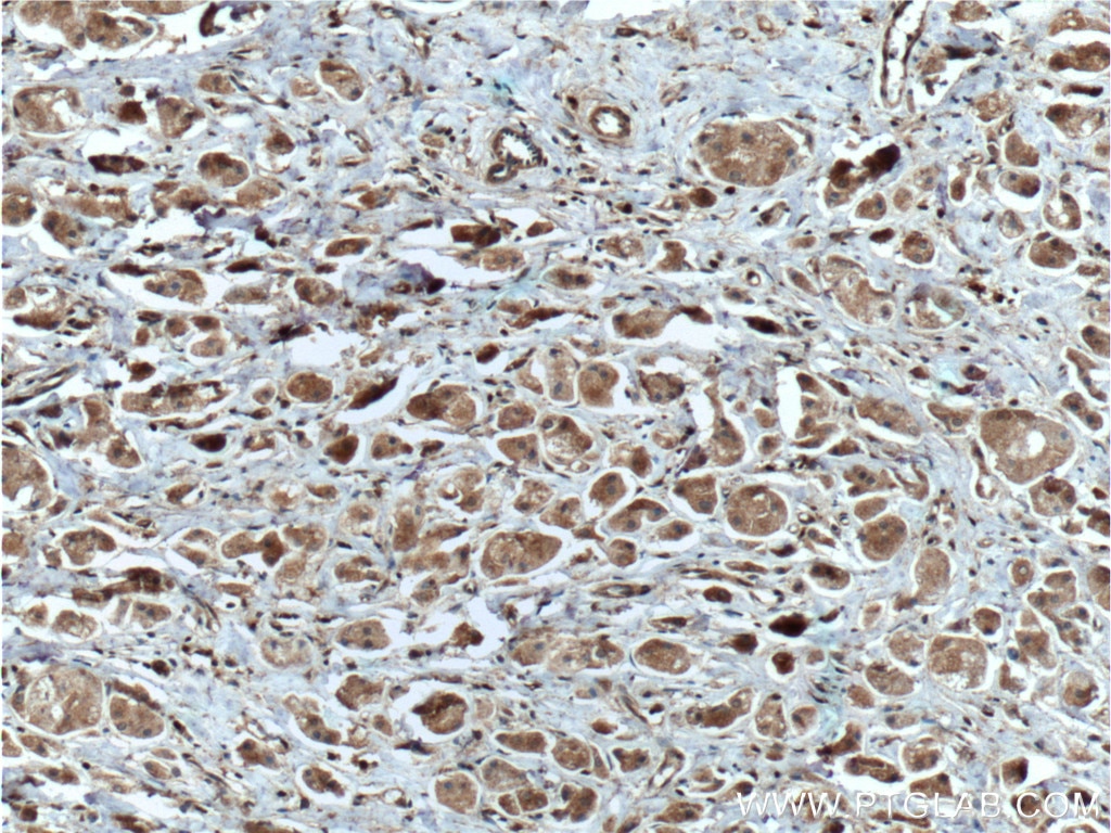 IHC staining of human breast cancer using 26910-1-AP