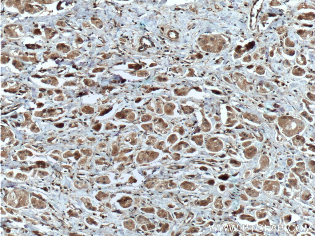 Immunohistochemistry (IHC) staining of human breast cancer tissue using DUSP7/PYST2 Polyclonal antibody (26910-1-AP)