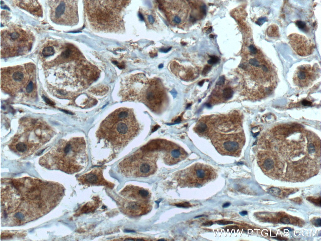 Immunohistochemistry (IHC) staining of human breast cancer tissue using DUSP7/PYST2 Polyclonal antibody (26910-1-AP)