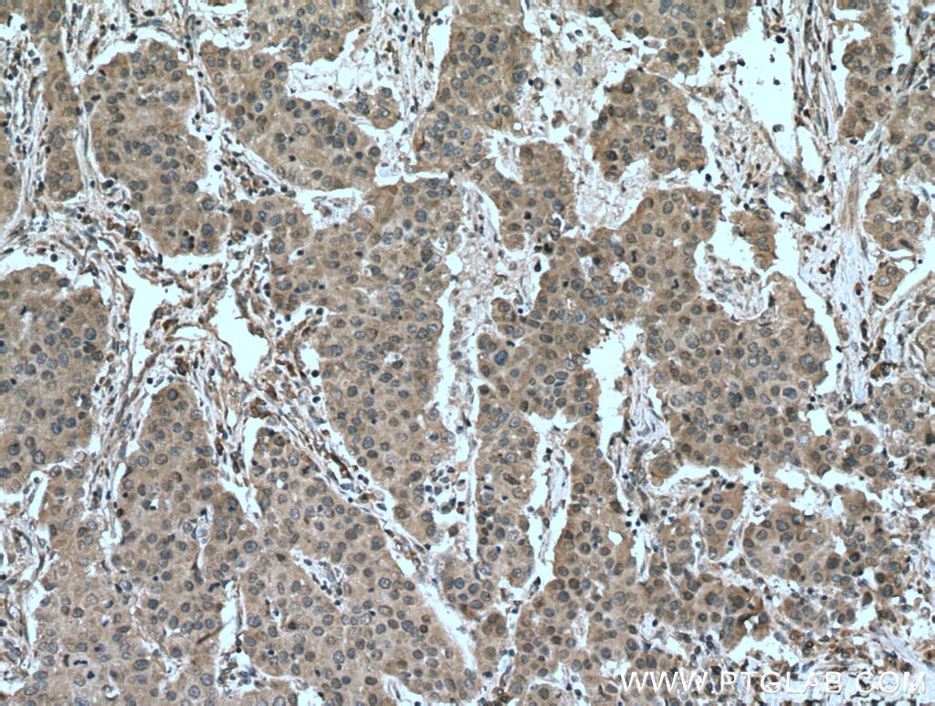 Immunohistochemistry (IHC) staining of human breast cancer tissue using DUSP9 Polyclonal antibody (26718-1-AP)