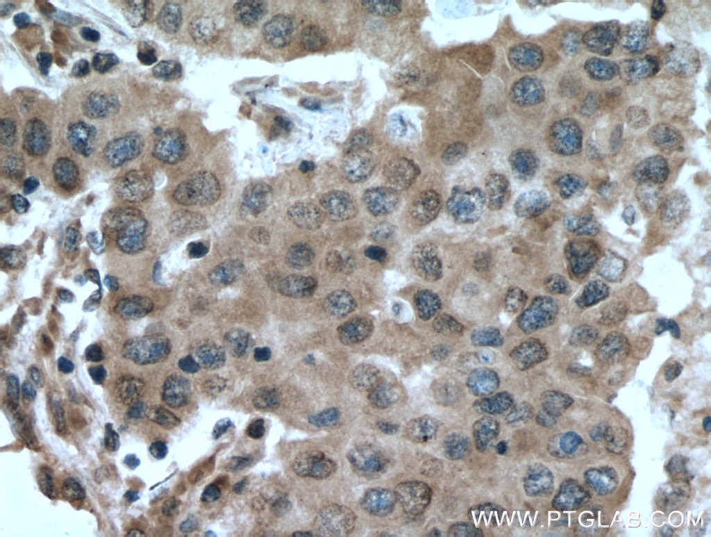 Immunohistochemistry (IHC) staining of human breast cancer tissue using DUSP9 Polyclonal antibody (26718-1-AP)