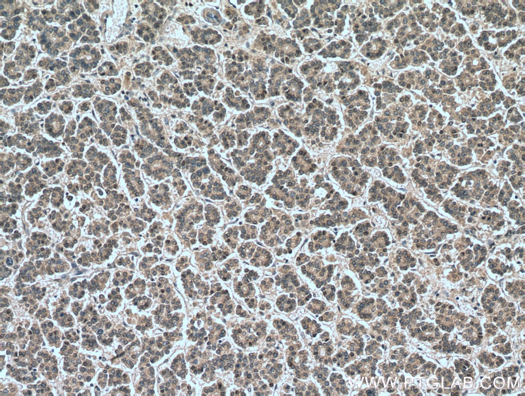 Immunohistochemistry (IHC) staining of human liver cancer tissue using DUSP9 Polyclonal antibody (26718-1-AP)