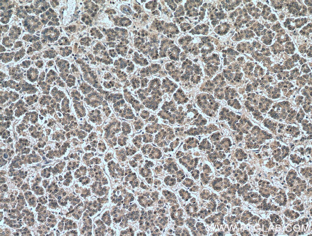 IHC staining of human liver cancer using 26718-1-AP