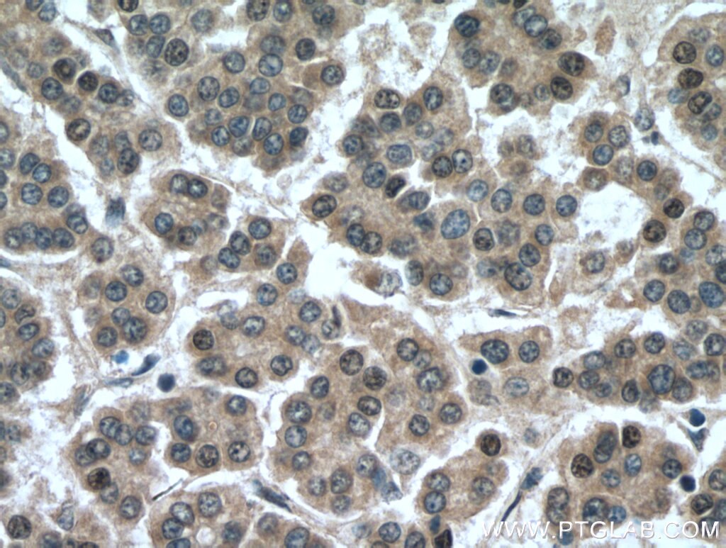 Immunohistochemistry (IHC) staining of human liver cancer tissue using DUSP9 Polyclonal antibody (26718-1-AP)