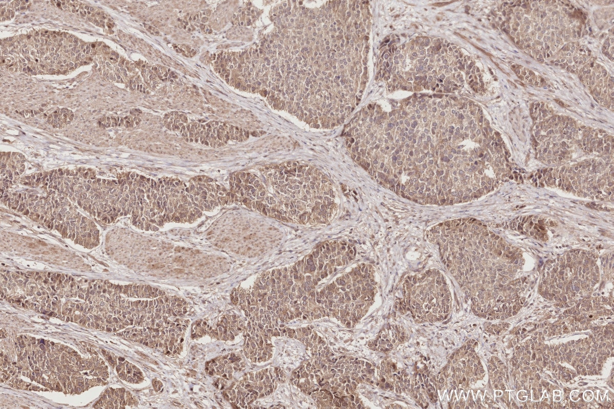 Immunohistochemistry (IHC) staining of human stomach cancer tissue using DUSP9 Polyclonal antibody (26718-1-AP)