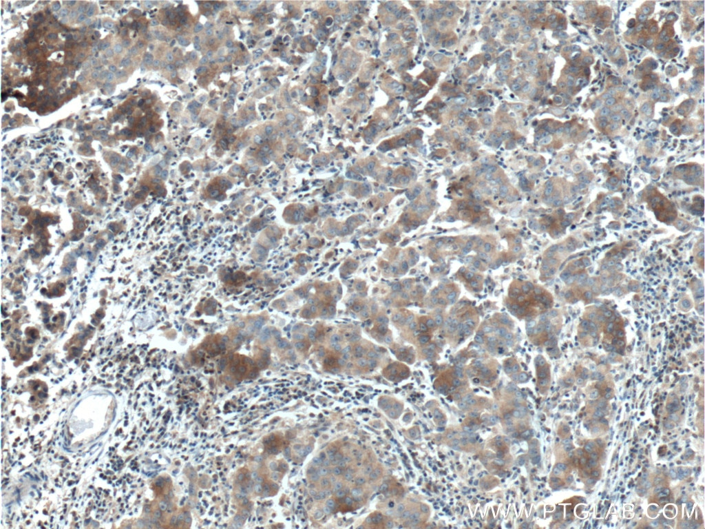 Immunohistochemistry (IHC) staining of human prostate cancer tissue using DVL1 Polyclonal antibody (27384-1-AP)