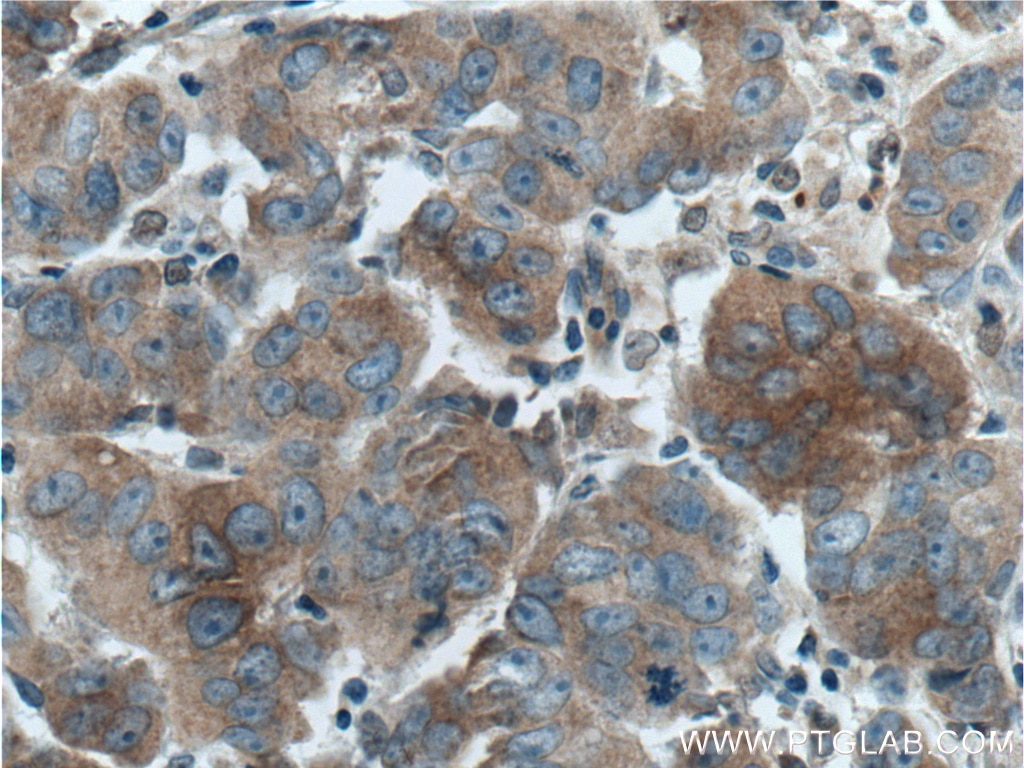 Immunohistochemistry (IHC) staining of human prostate cancer tissue using DVL1 Polyclonal antibody (27384-1-AP)